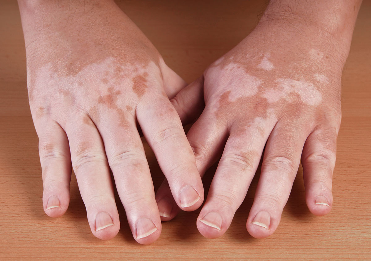 Vitiligo hands