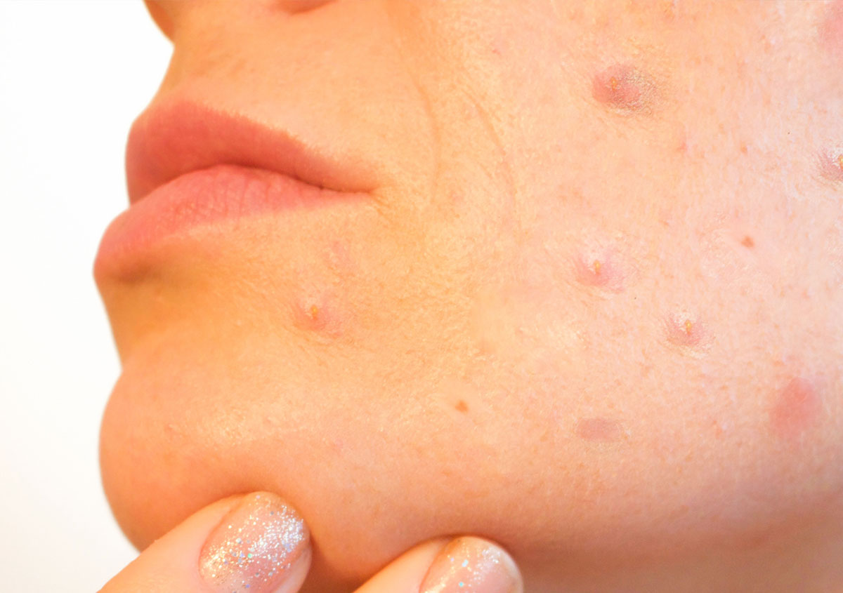 Woman face with acne
