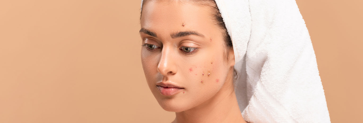 Woman with Acne