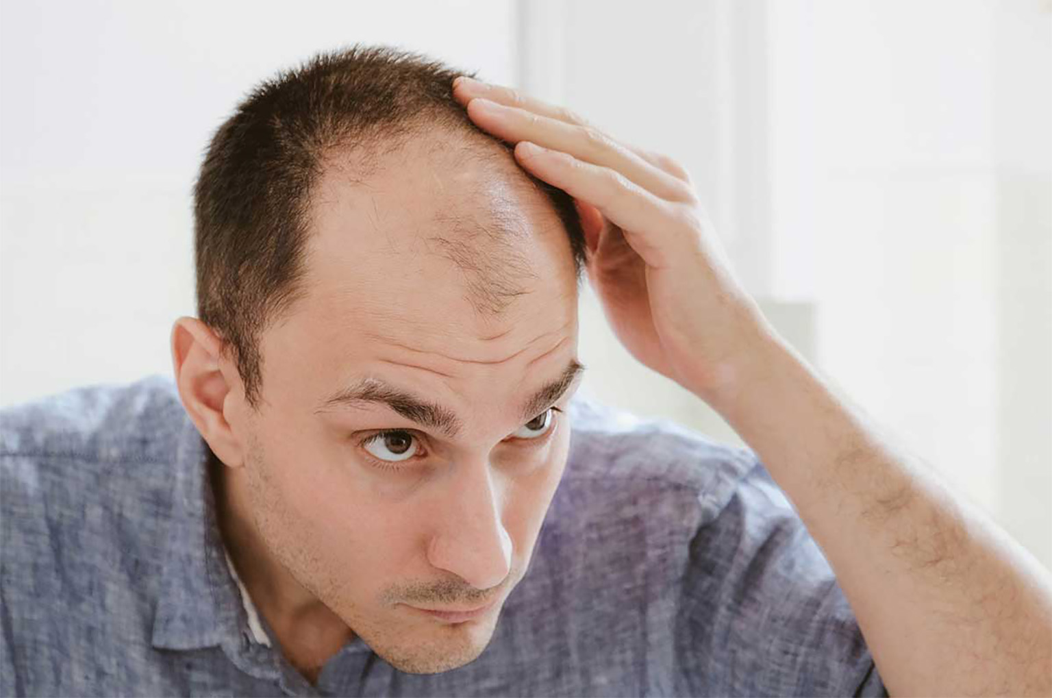 Suffering from Male Pattern Baldness? These Treatments Can Help